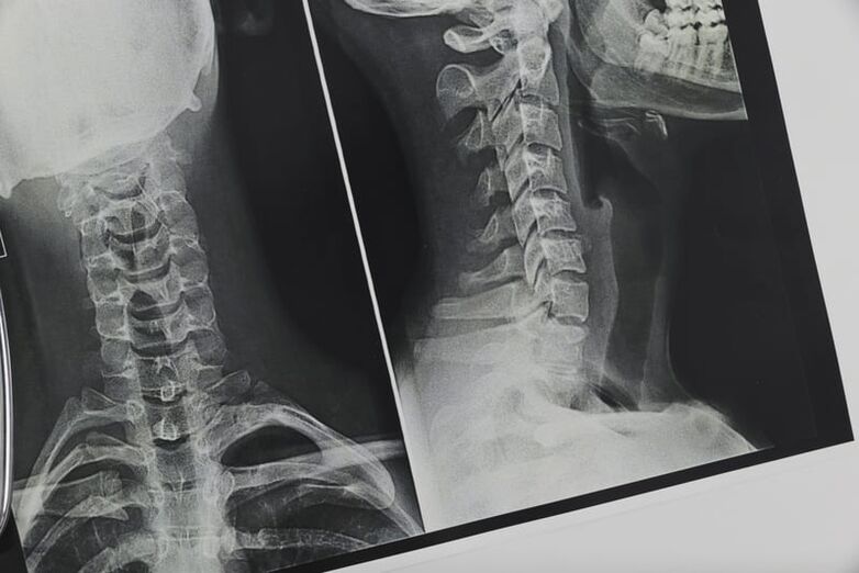 Osteohondrozes skartā mugurkaula kakla rentgenogrāfija