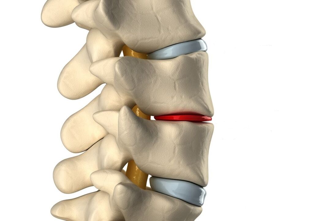 Vesels starpskriemeļu disks (zils) un bojāts krūšu kurvja osteohondrozes dēļ (sarkans)