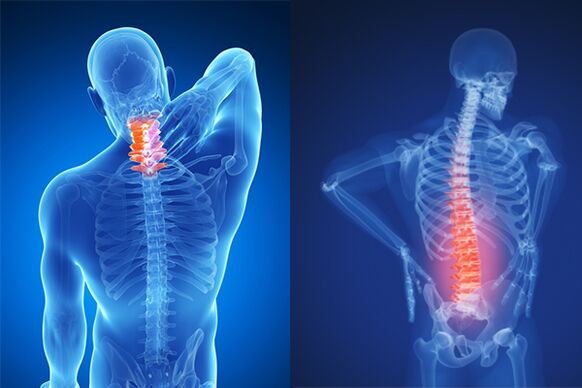 Mugurkaula kakla un jostas daļas osteohondroze