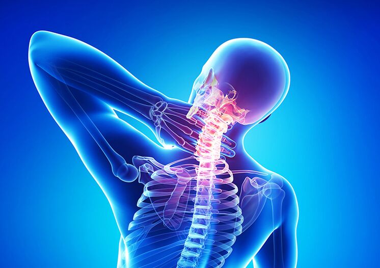 Mugurkaula osteohondroze ir slimība, kas ietekmē locītavu skrimšļus un skriemeļus.